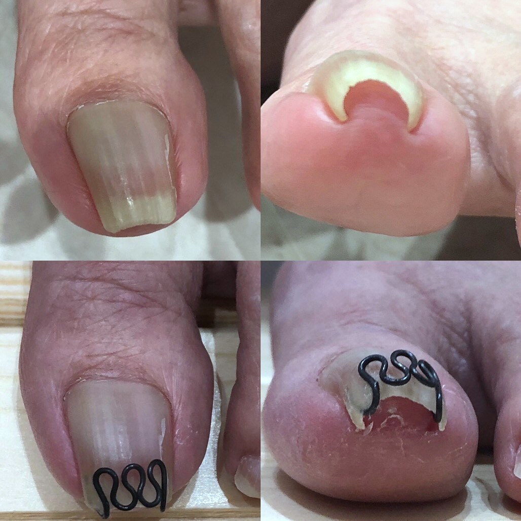巻き爪ケアのビフォーアフター