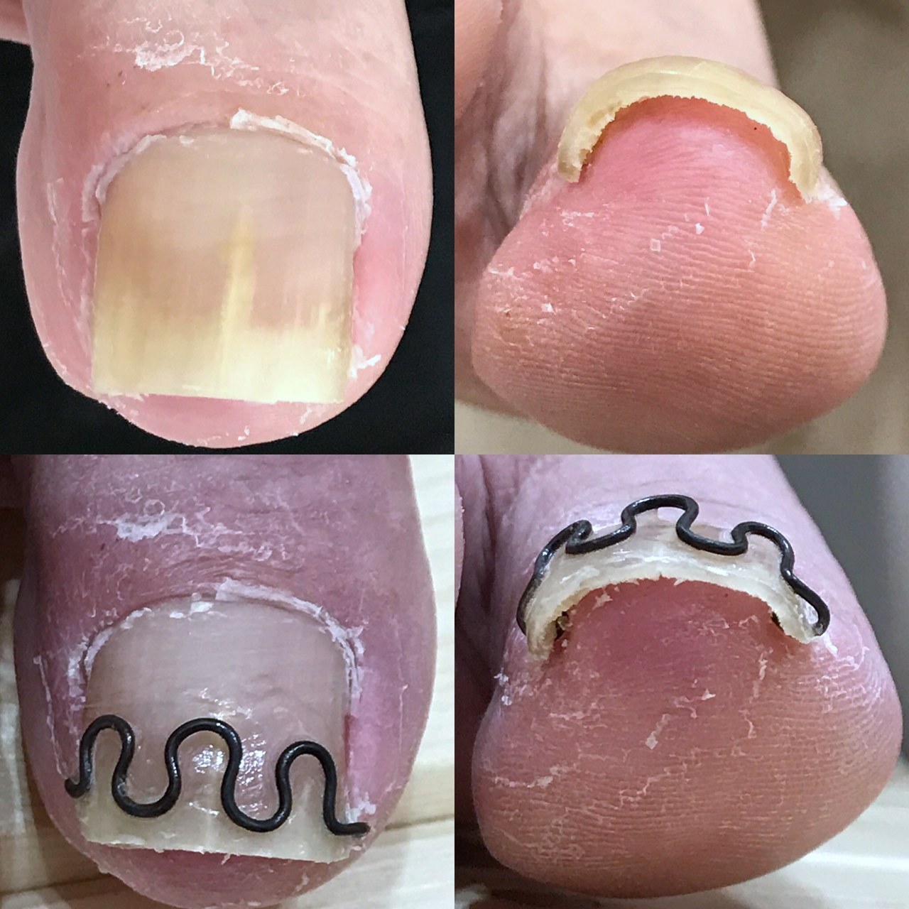 巻き爪ケアのビフォーアフター