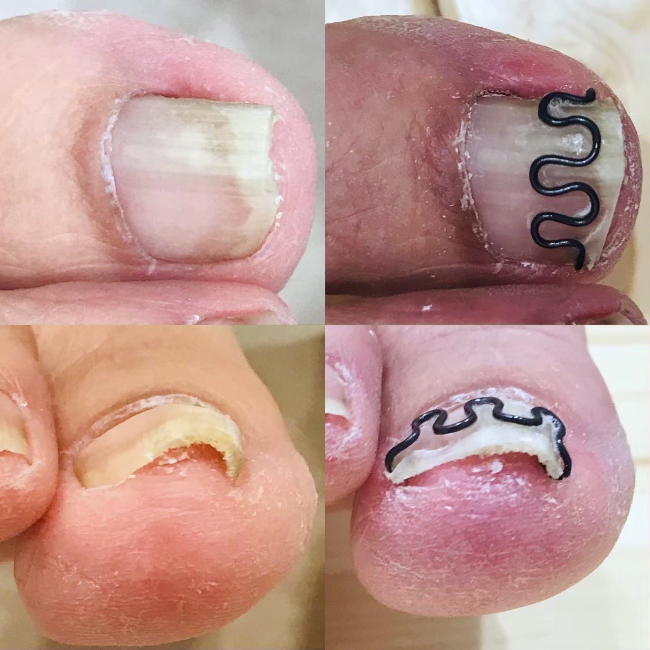 巻き爪ケアのビフォーアフター